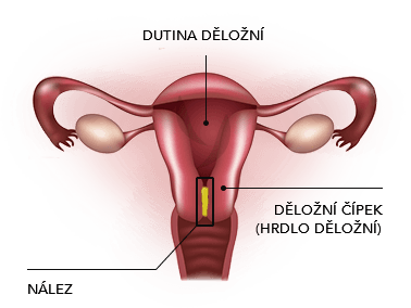 konizace děložního hrdla